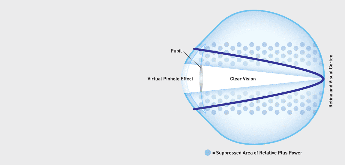 Clear vision multi focus contact lens illustrating virtual pinhole effect allowing wider range of vision